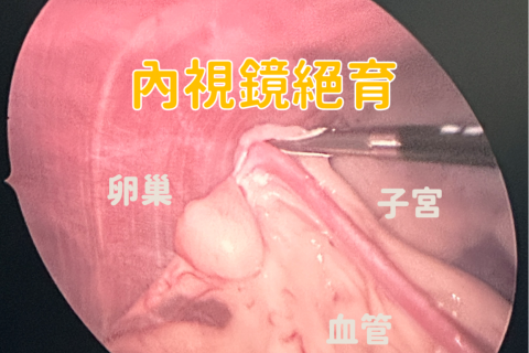 【外科】腹腔內視鏡絕育手術